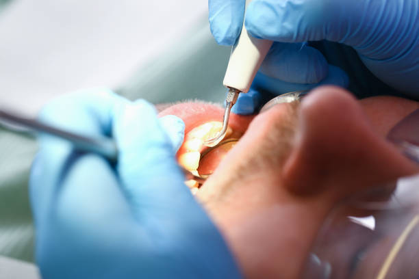 Best Emergency Dental Care for Sports Injuries in Litchfield, MN